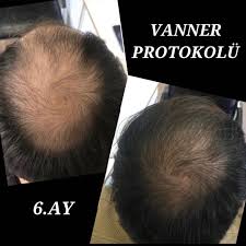 Vanner hair protokolü